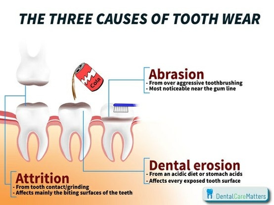 tooth-wear-dental-care-crown-dentist-david-cote