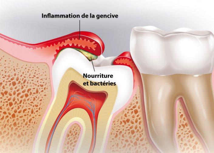 inflammation-gencive-dent sagesse-martin-dubois-maxillo-facial-gatineau