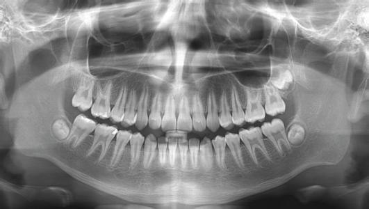 radiographie-numérique3D-head-jaws-gatineau