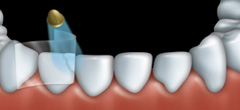 mordançage-réparation-dent-minuwere-dentiste-gatineau