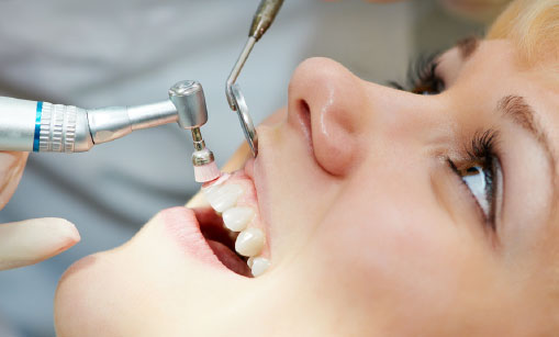 dentiste-gatineau-detartrage-sels-mineraux-fluor