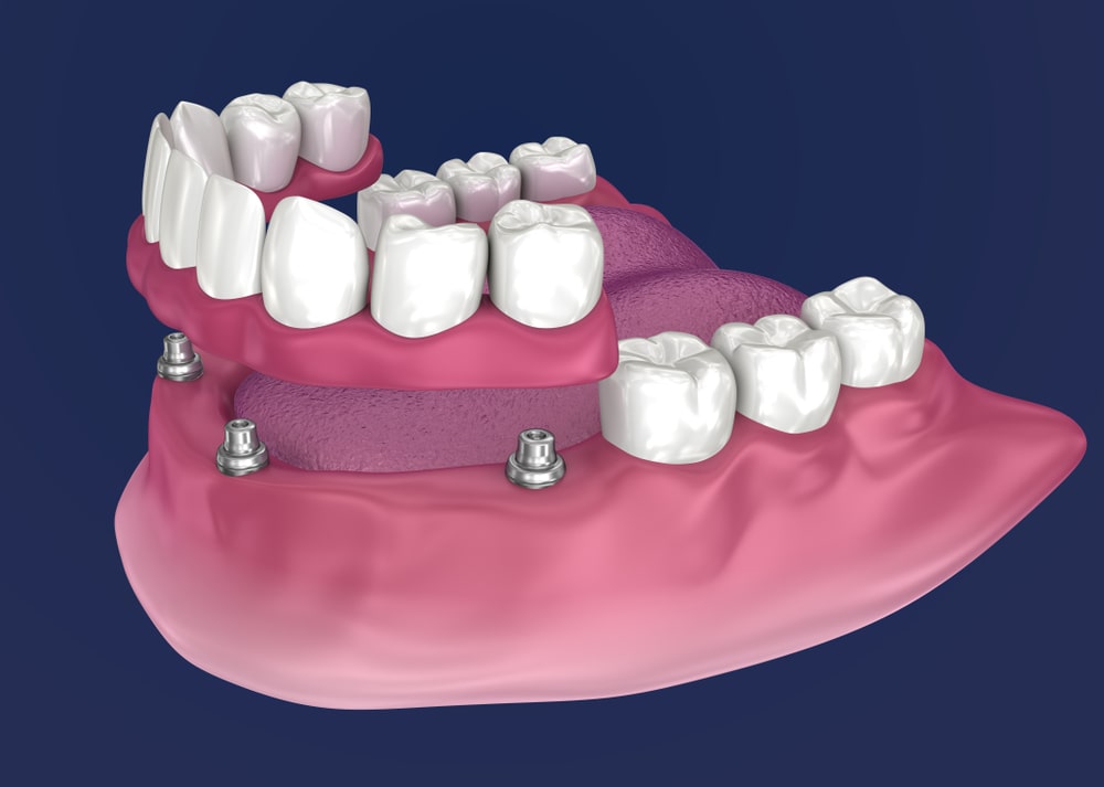Implants_Dentaires_Dentiste_Gatineau