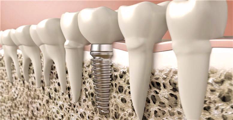 implant_dentaire_avantages-longue-durée