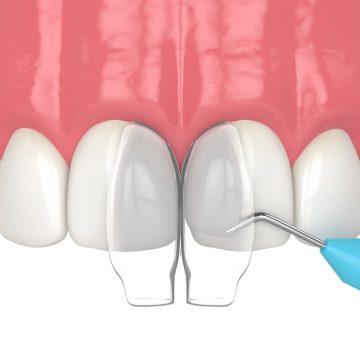 Illustration montrant la fermeture d'un espace entre les incisives supérieures avec la technique Bioclear