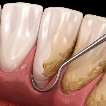 Illustration 3D montrant le surfaçage radiculaire